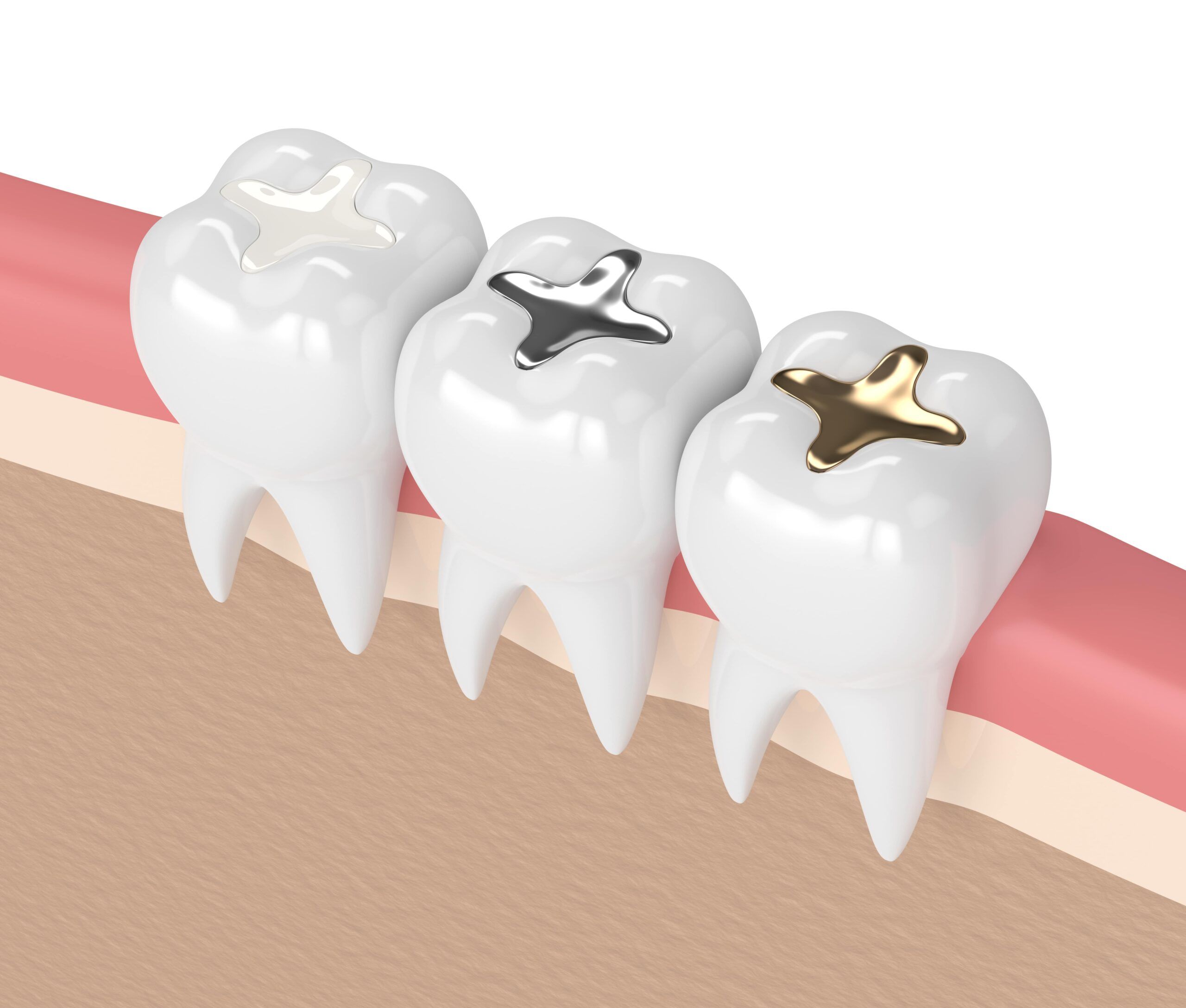 different types of fillings composite, silver, gold