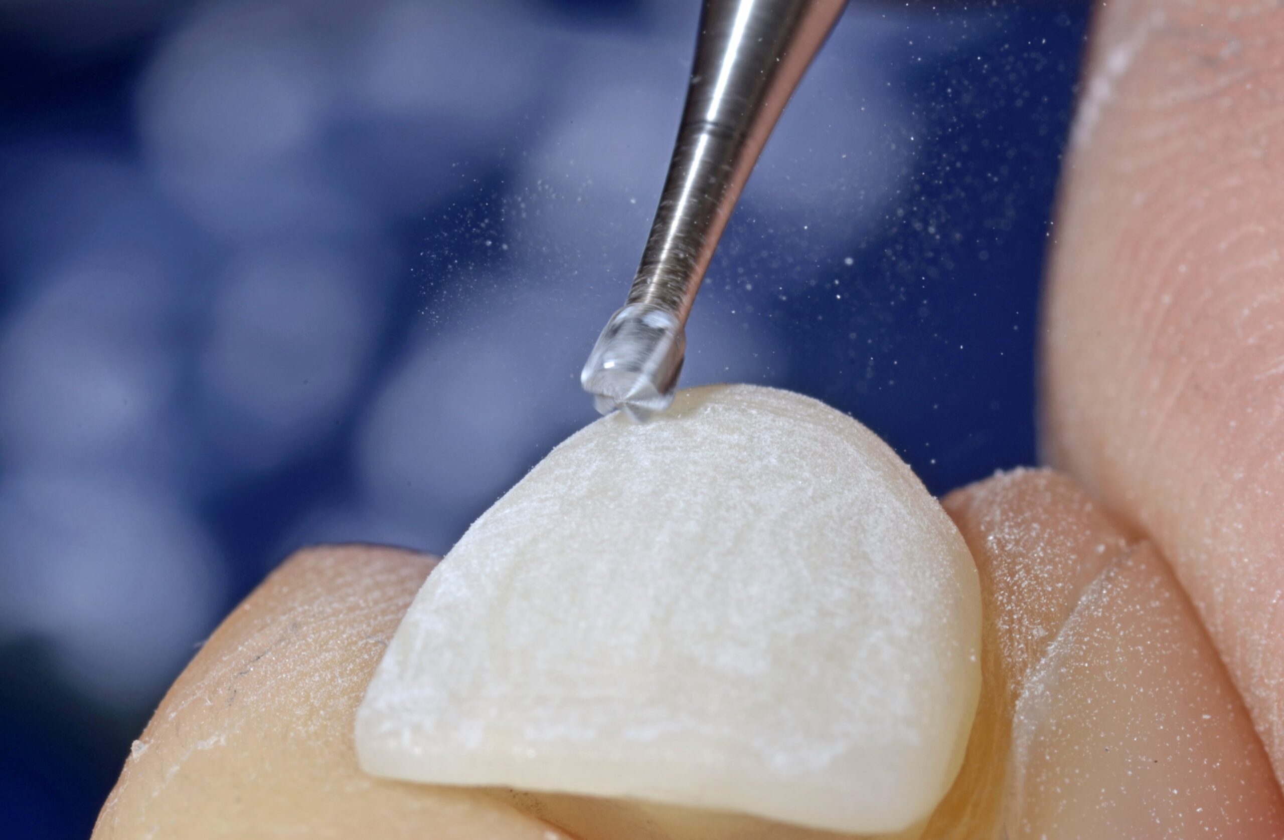 dental crown being fabricated