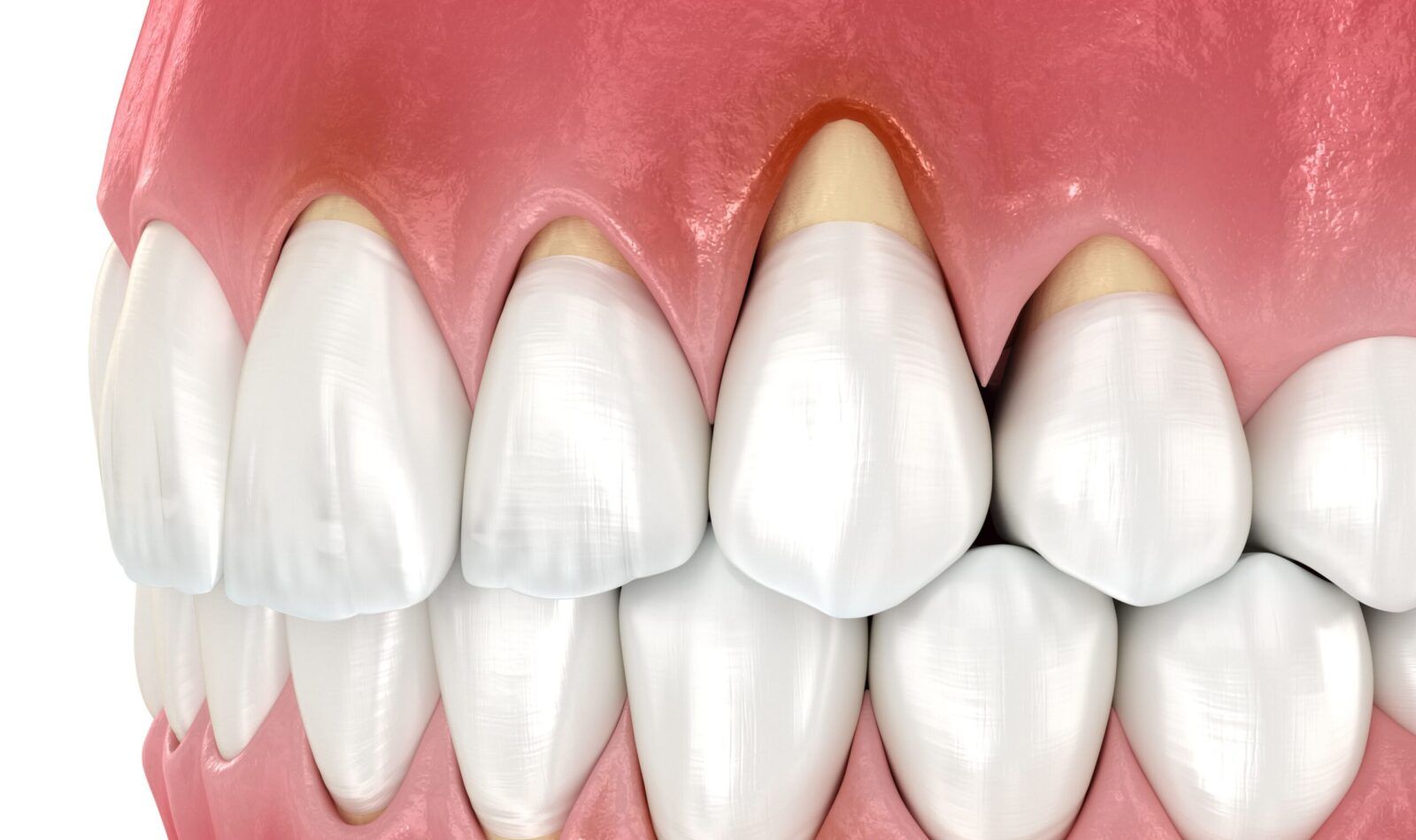 gum recession in upper and lower teeth