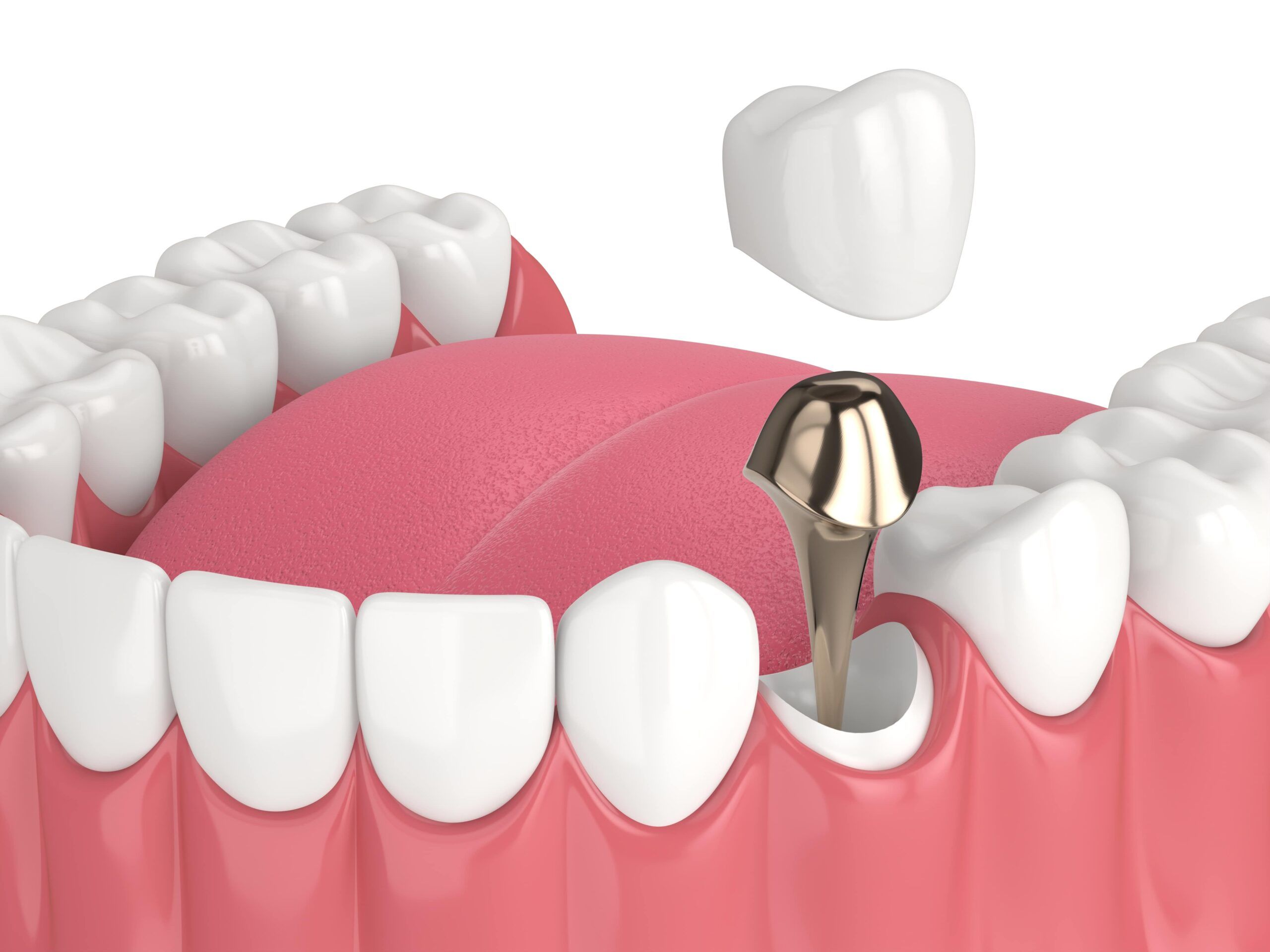 3d render of lower jaw with cast post and core tooth restoration over white background