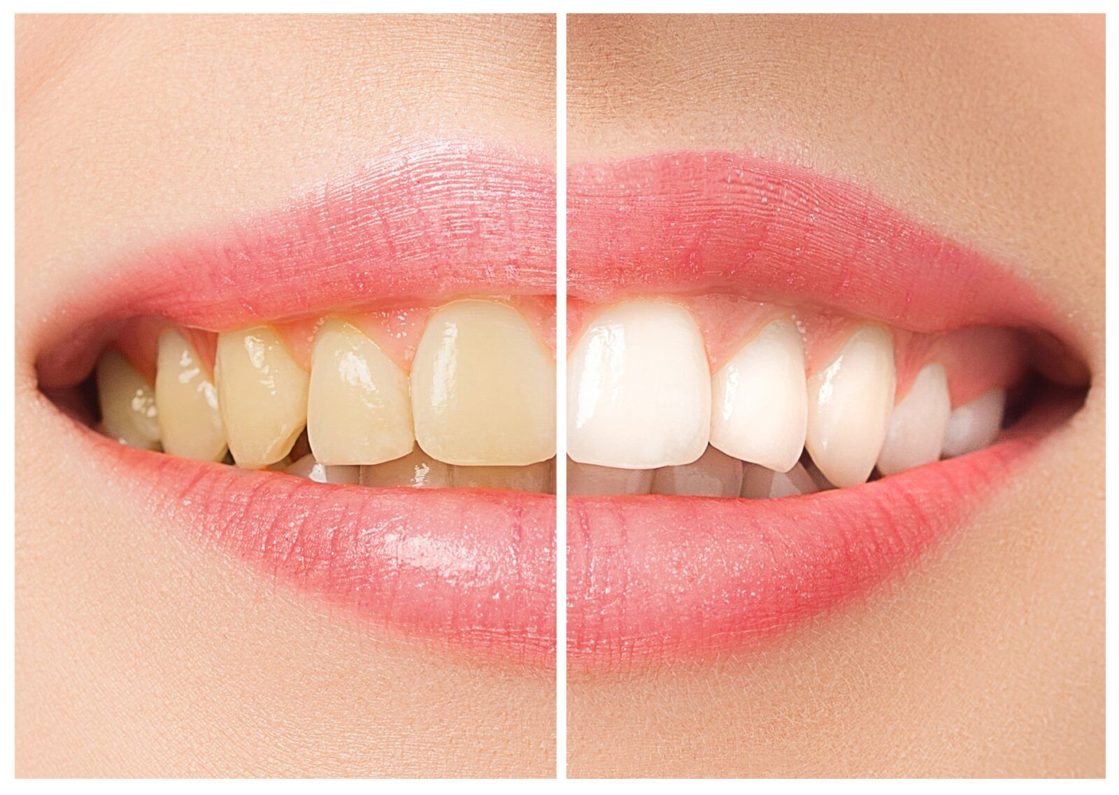 before and after teeth whitening
