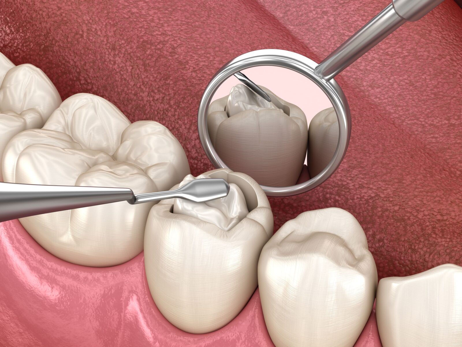 dental filling being placed in tooth