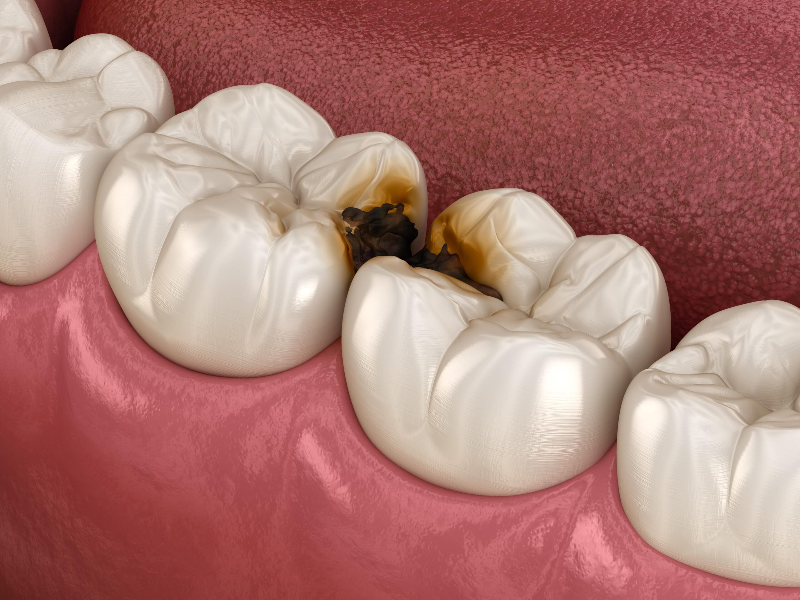 dental decay shown between two molars