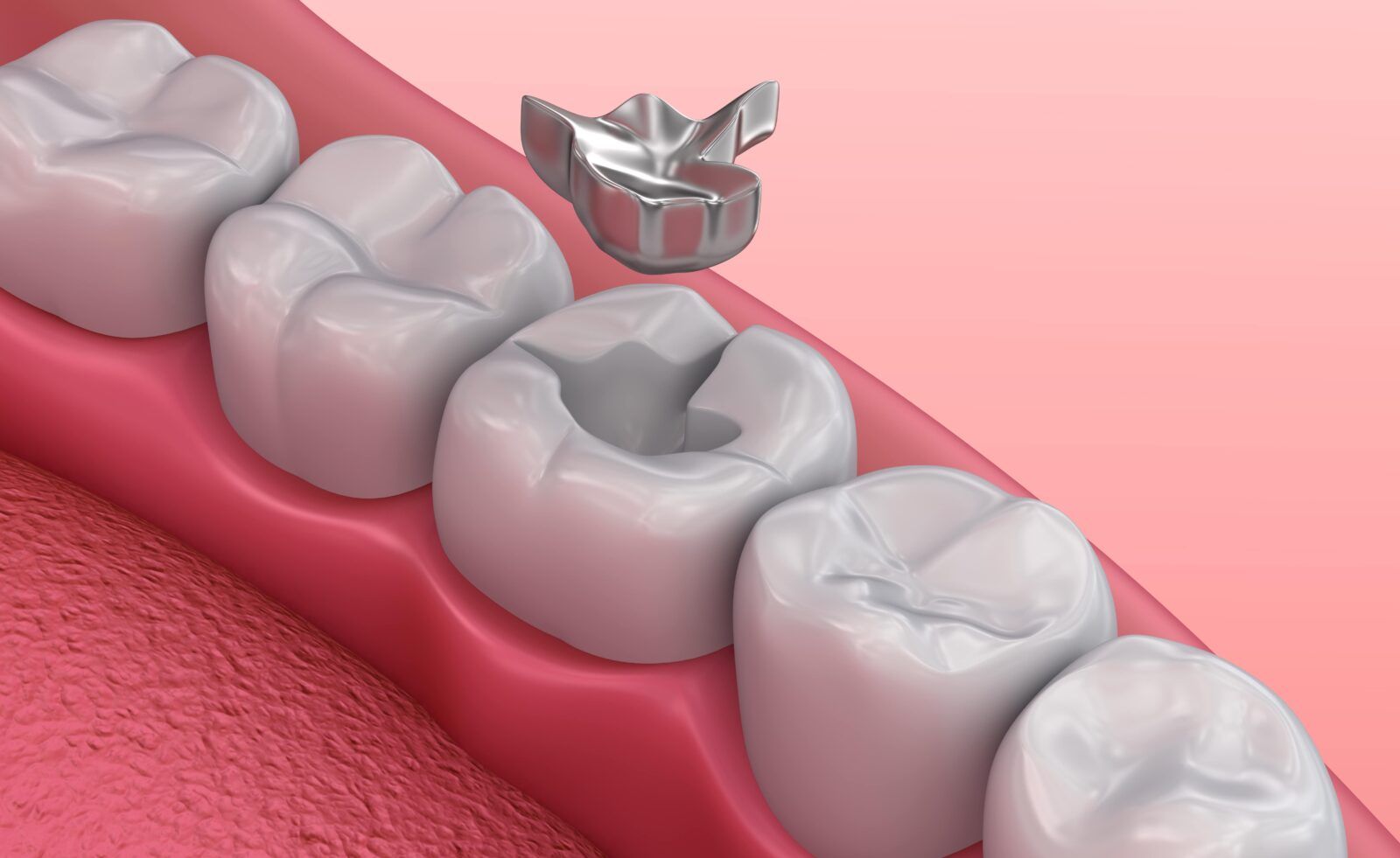 metal filling being placed in molar. dental illustration