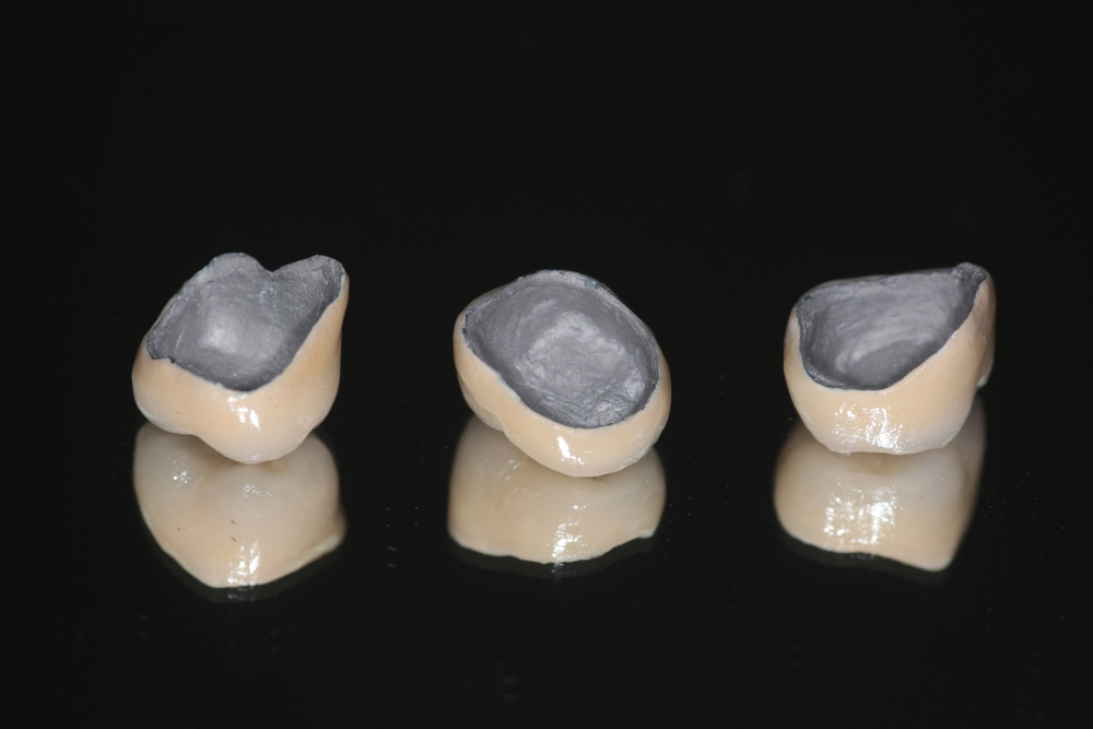 An example of PFM Restorations 