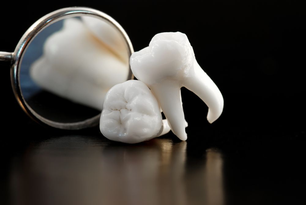 An example of a Wisdom Tooth taken out during a Tooth Extraction