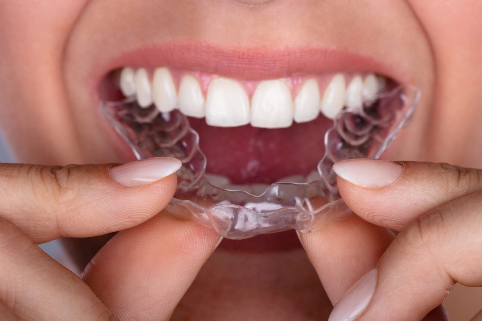 woman placing invisalign aligner in her mouth