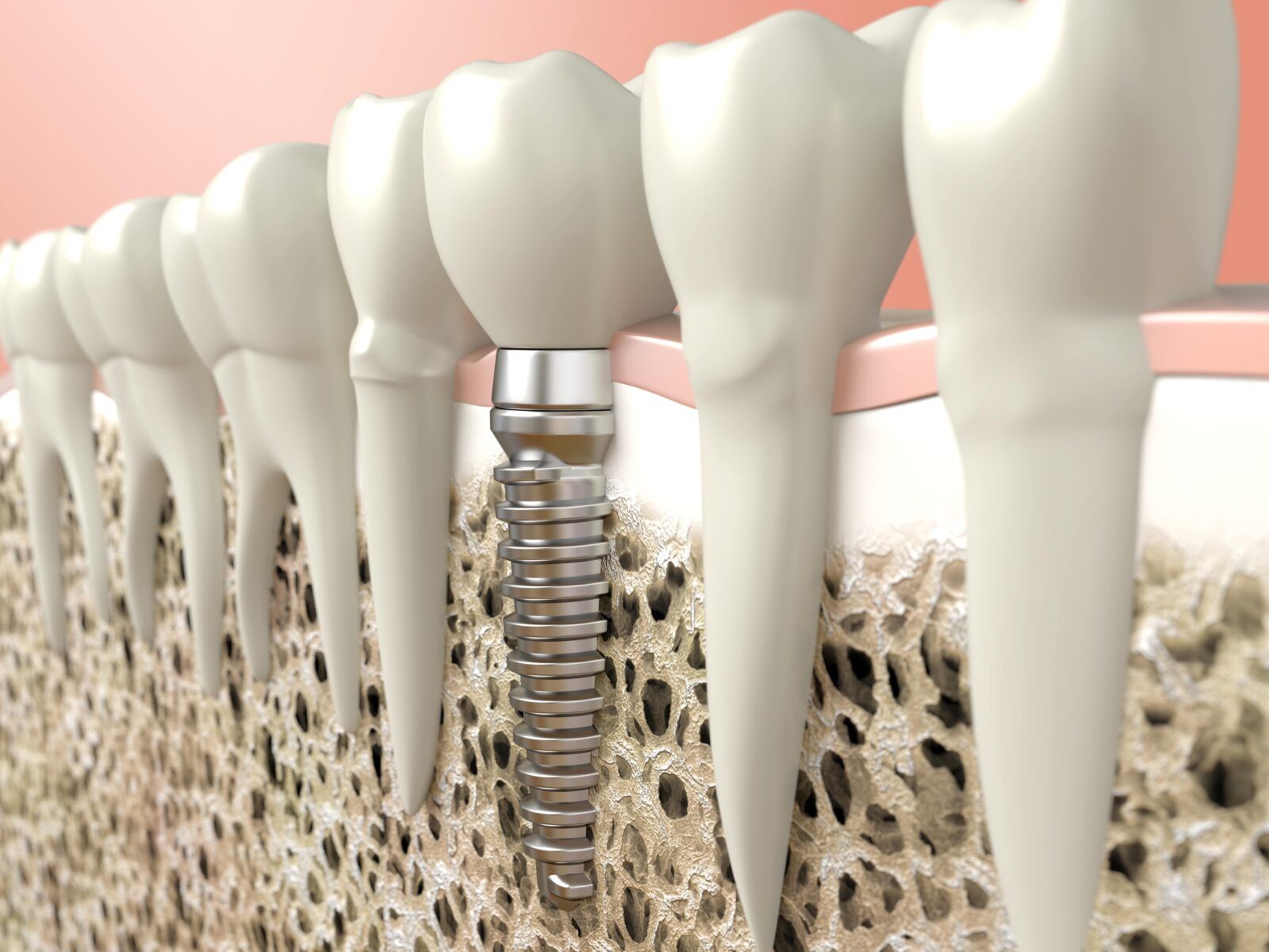 dental implant in bone