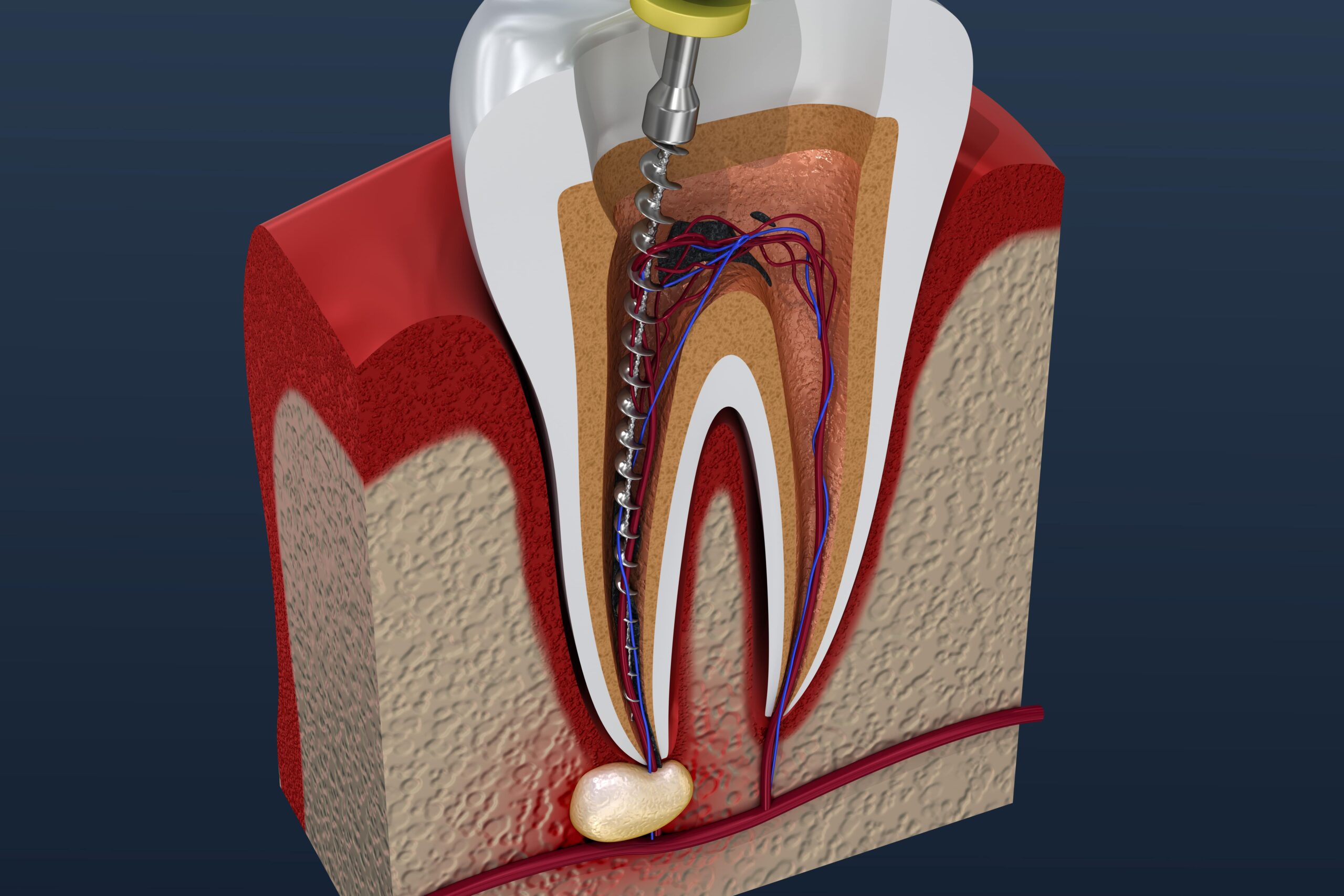 dental file being used to clean out the inside of the tooth