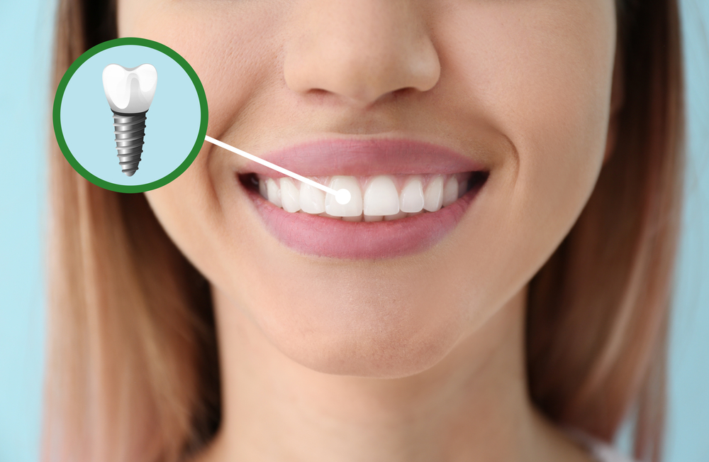 How to care for dental implants