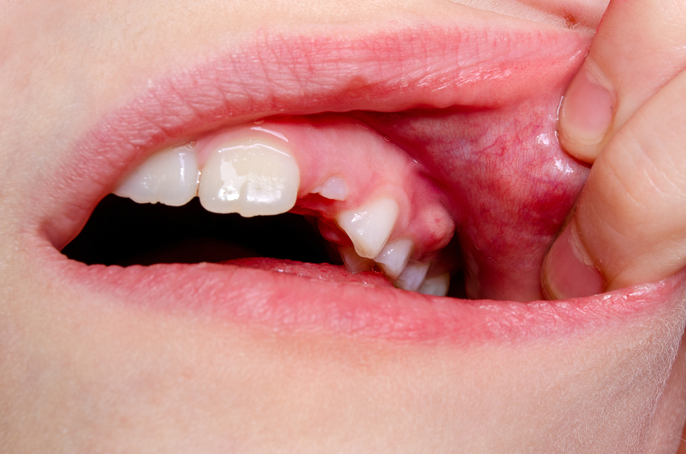 How to handle a dental abscess