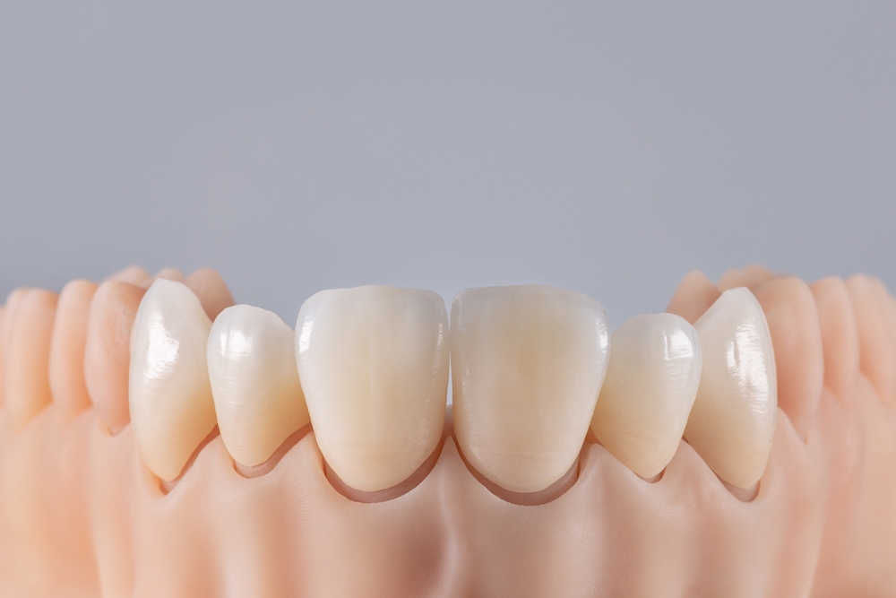 The Process of Getting Dental Crowns