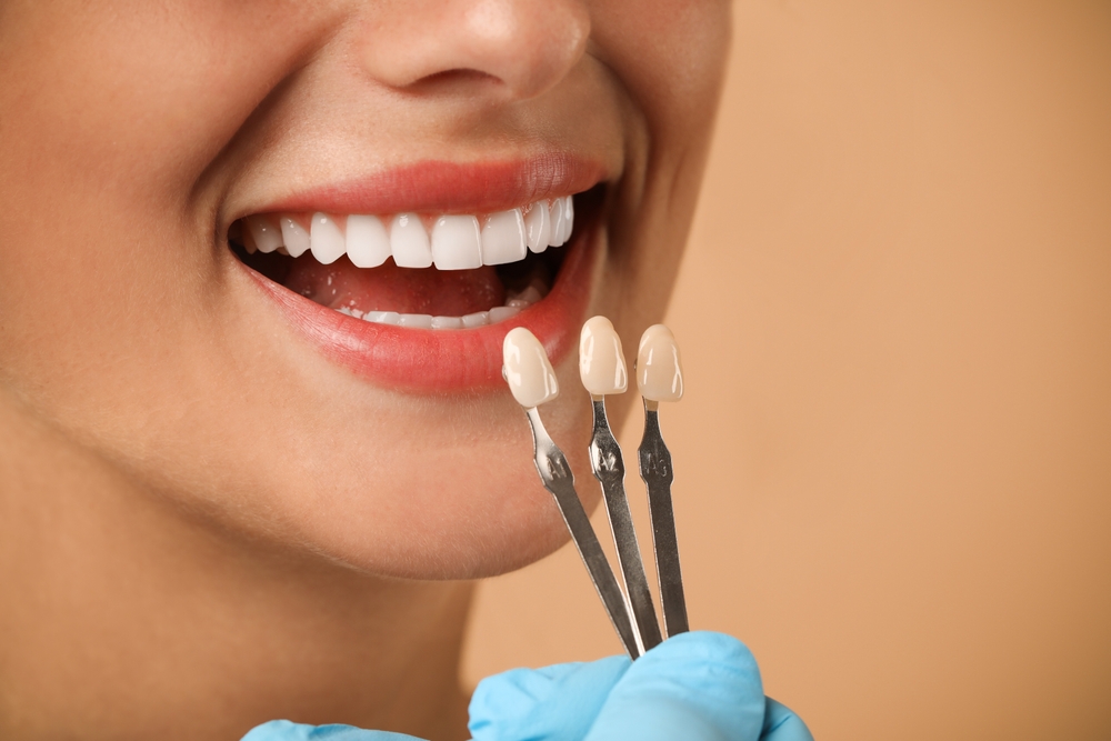 The Different Types of Dental Veneers