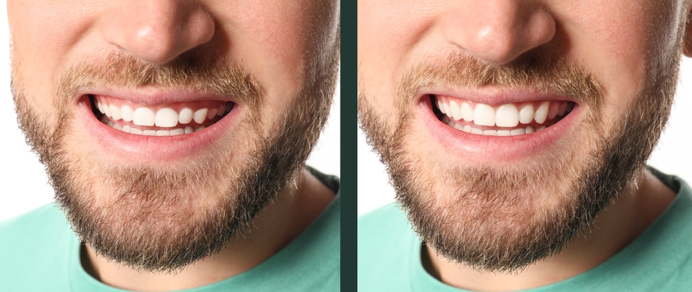 The Benefits of Gum Contouring for Smile Enhancement