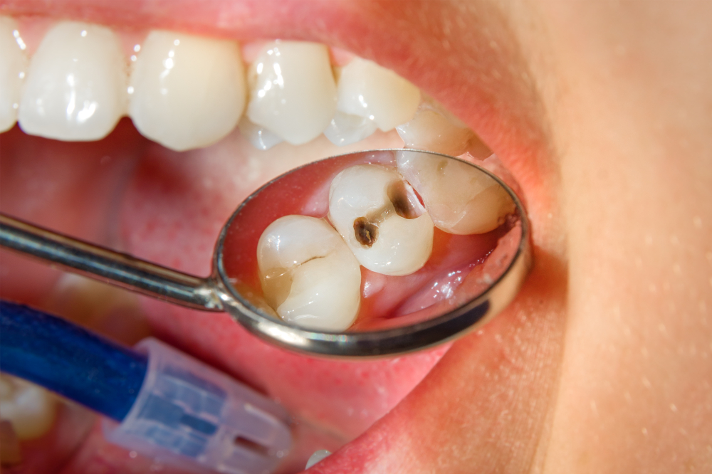 Cavity Under a Dental Crown