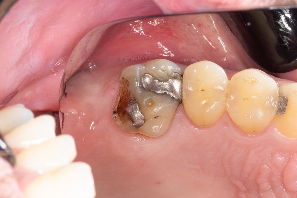 Broken,Amalgam,Filling,Restoration,Dental