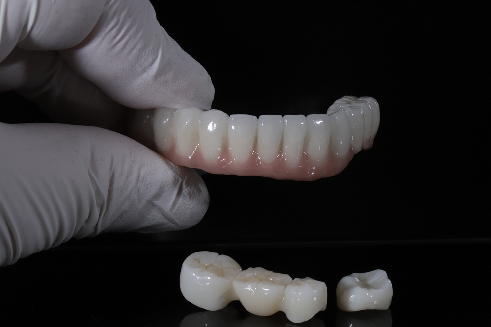 Glass-ceramic porcelain laminate veneers and zirconium crown bridge prostheses
