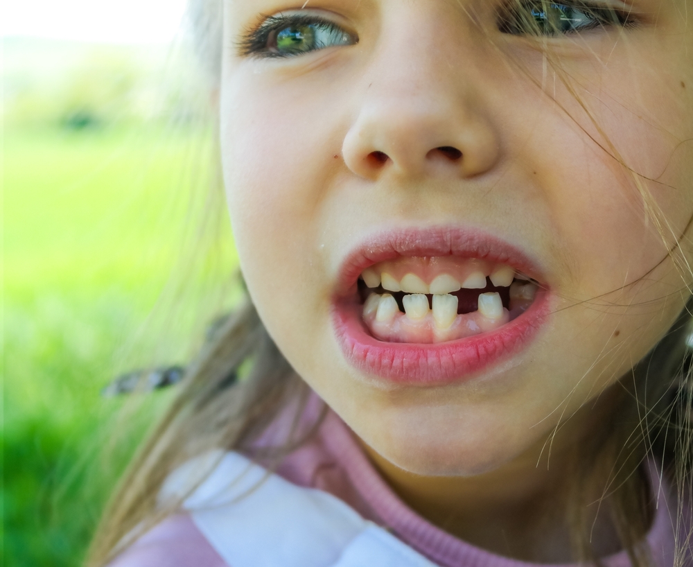 The smile of a cute girl. Three teeth have fallen out