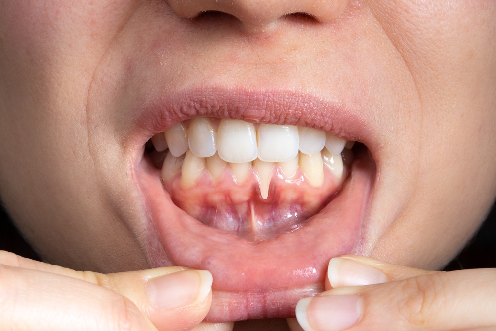 Macro of a female mouth with receding gums. Close-up of a woma