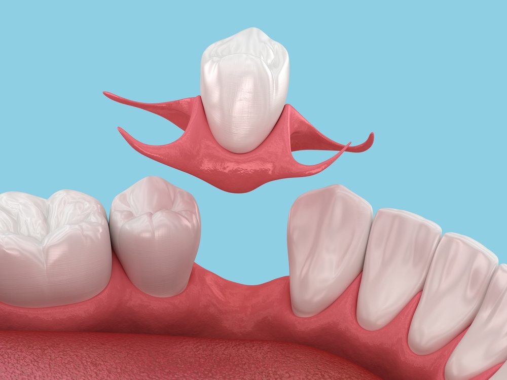 Partial,Removable,Immediate denture,Type,Butterfly.,Replacement,Of,One,Missing,Tooth