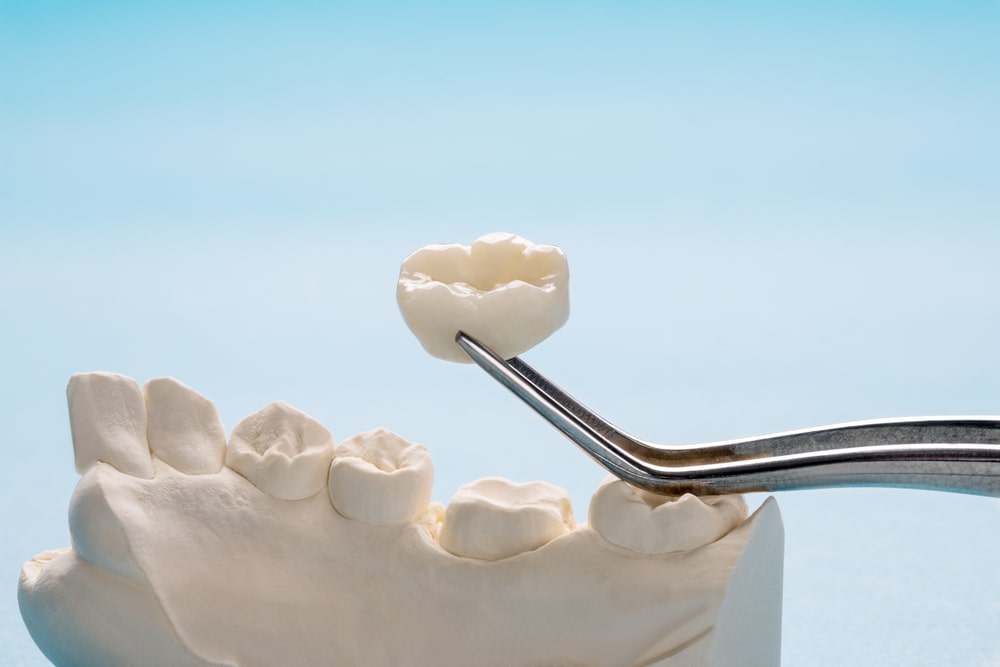 Closeup / Prosthodontics or Prosthetic / Single teeth crown and bridge equipment model express fix restoration.