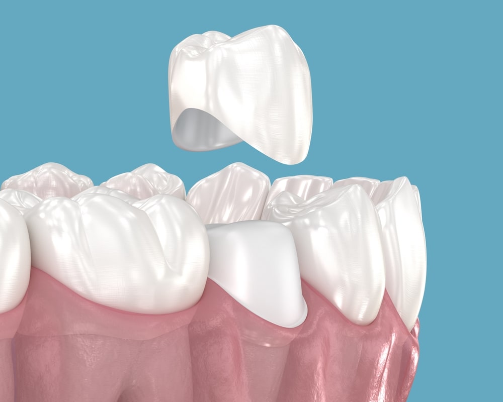 Dental crown placement over tooth. 3D illustration