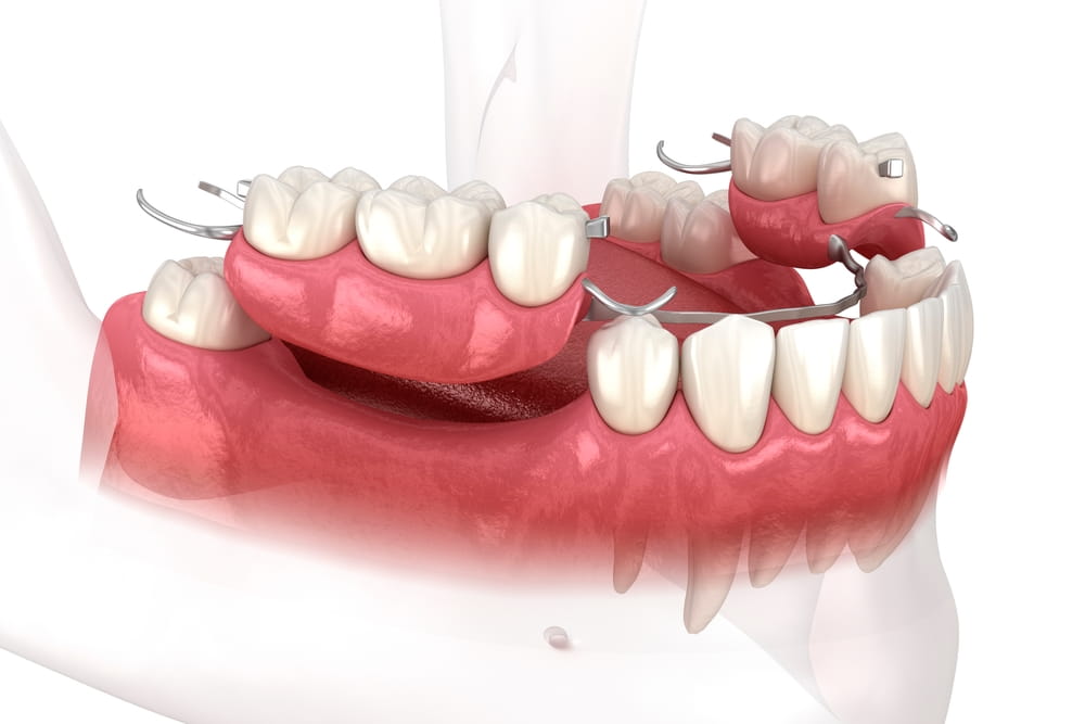 Removable partial denture, mandibular prosthesis. Medically accurate 3D illustration of prosthodontics concept