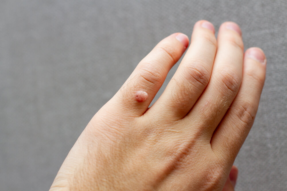 Finger wart on hand. Health concept. body wart