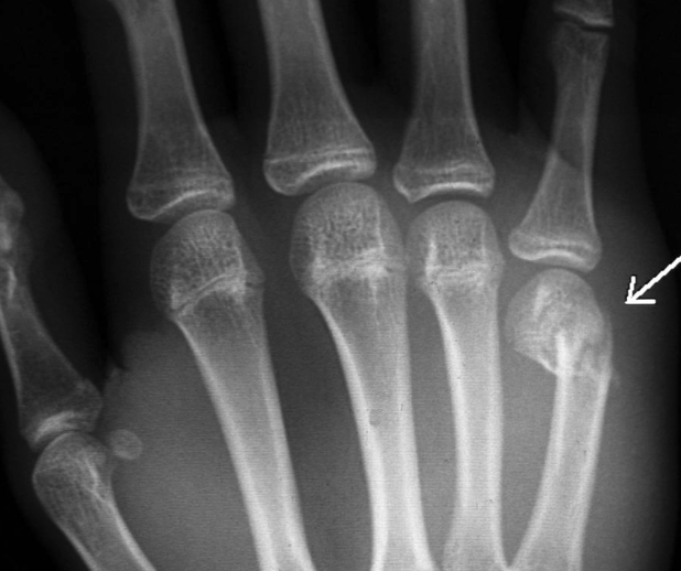 Fractured finger bone