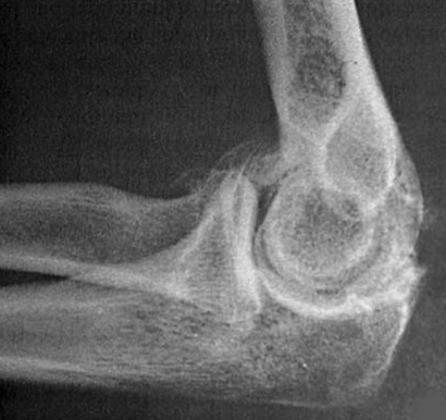 Elbow Arthritis