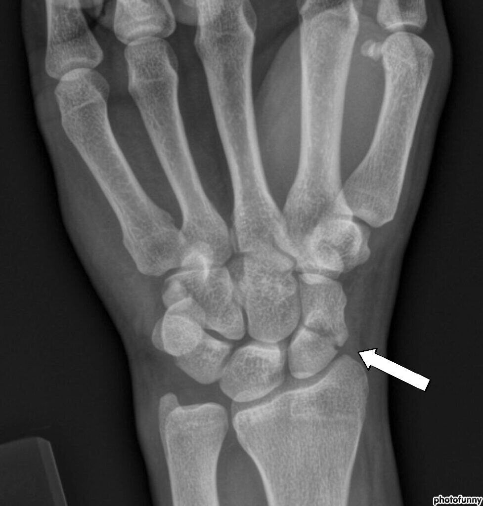 X-ray image of wrist joint
