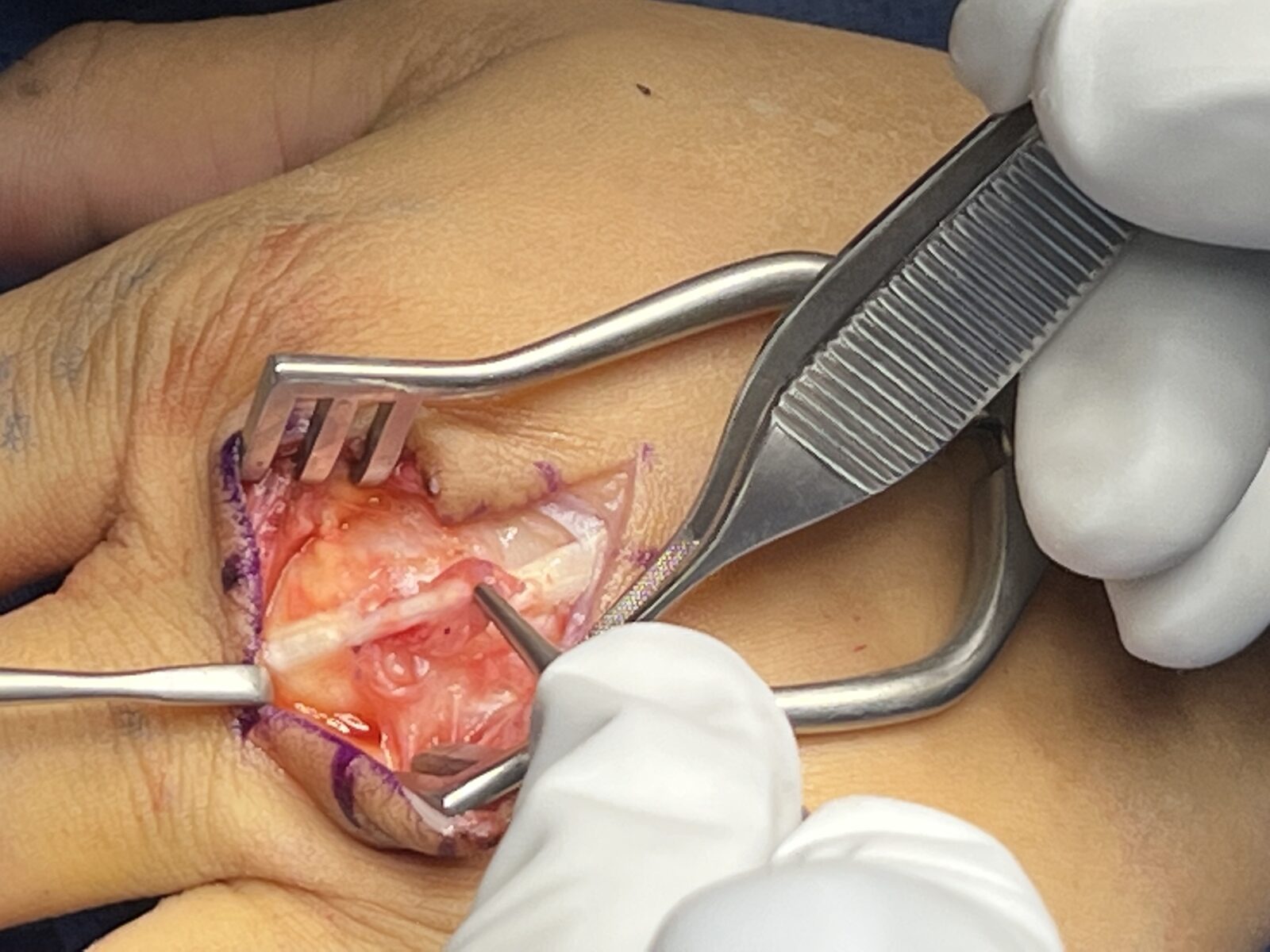 Surgeon performing Tendon surgery