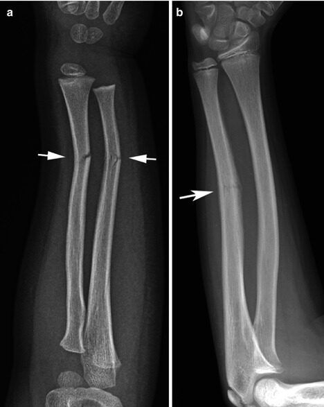 Xray showing fractured bones of arm
