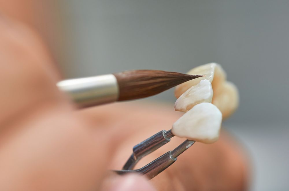 Closeup Of Dental Technician Putting Ceramic To Dental Implants In