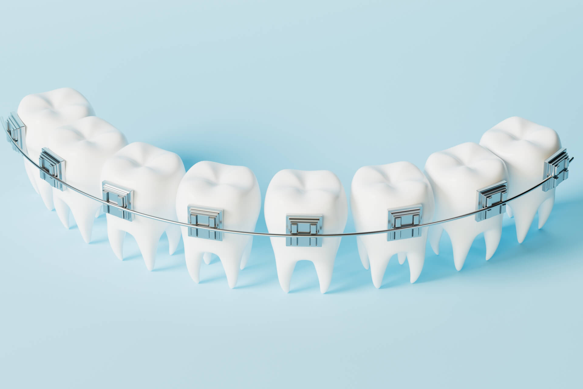 Teeth brace in the blue background, 3d rendering. Computer digital drawing.