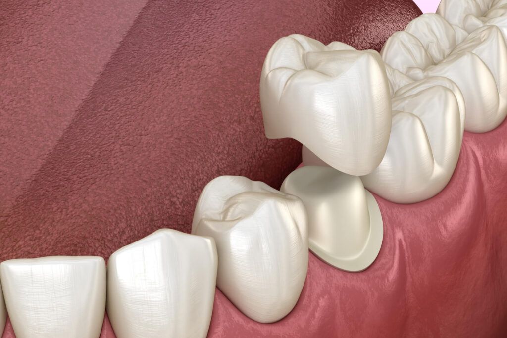 Preparated premolar tooth and dental metal-ceramic crown.