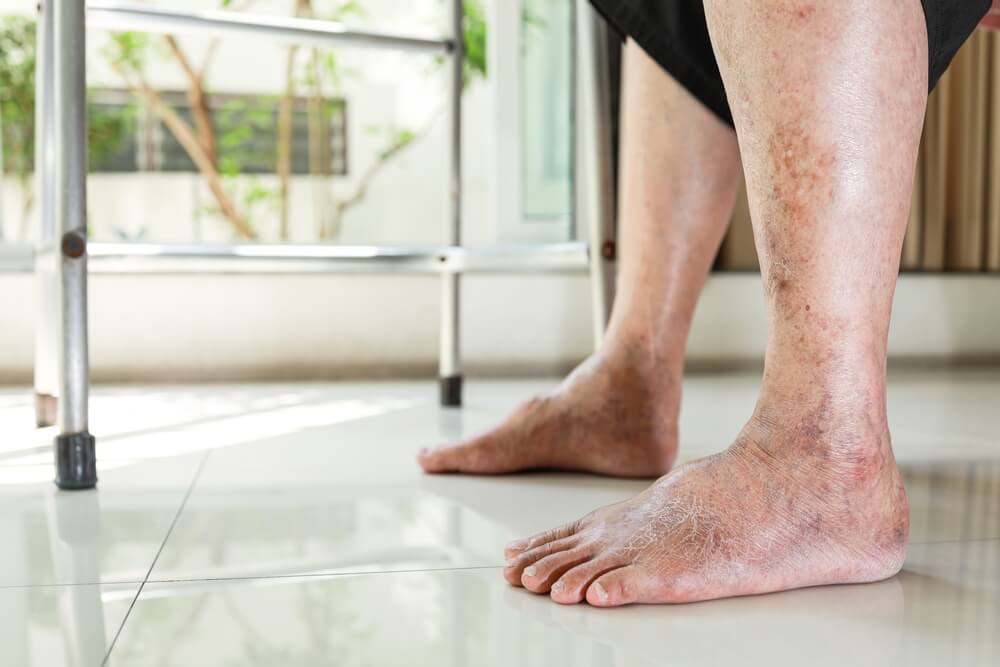 Closeup,Asian old senior with swollen feet