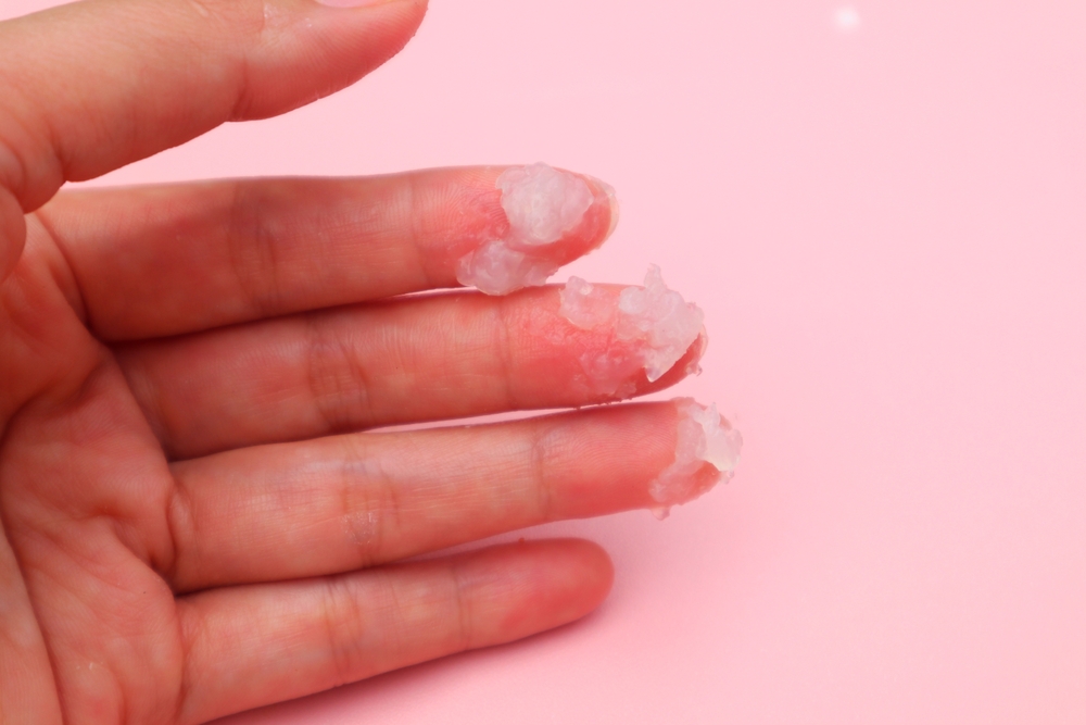A woman's hand holds fluid or vaginal discharge in women (fluor albus, leucorrhea,