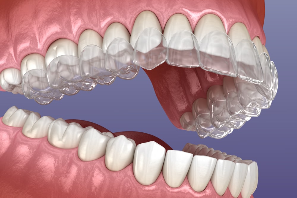 Invisalign braces or invisible retainer. Medically accurate dental 3D illustration