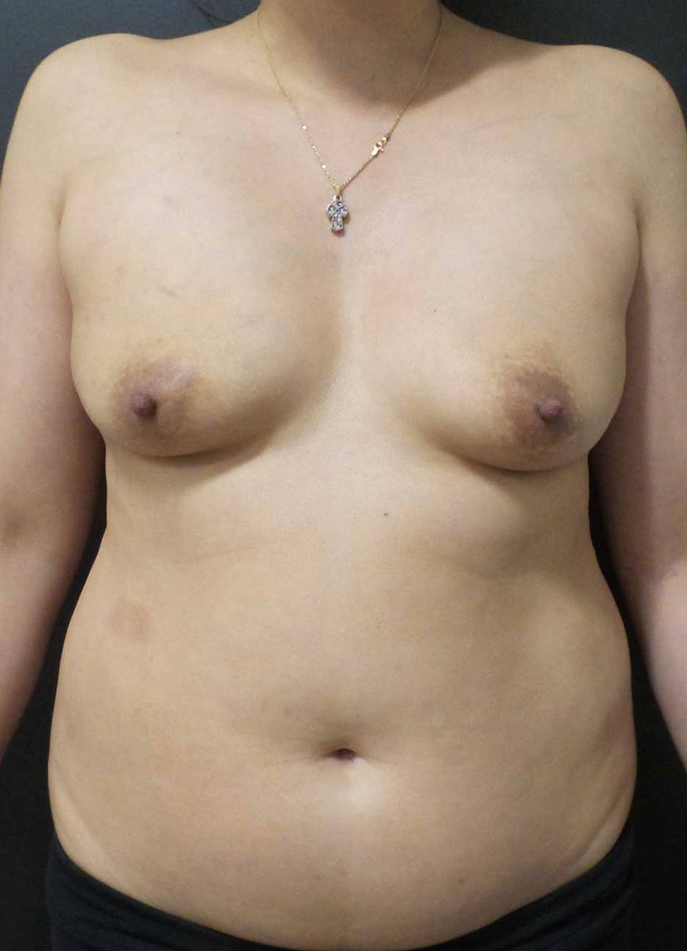 Before Bilateral DIEP Flaps Treatment