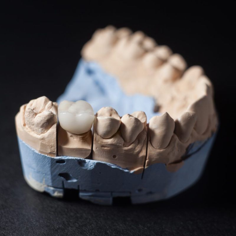 Gypsum model plaster of teeth.