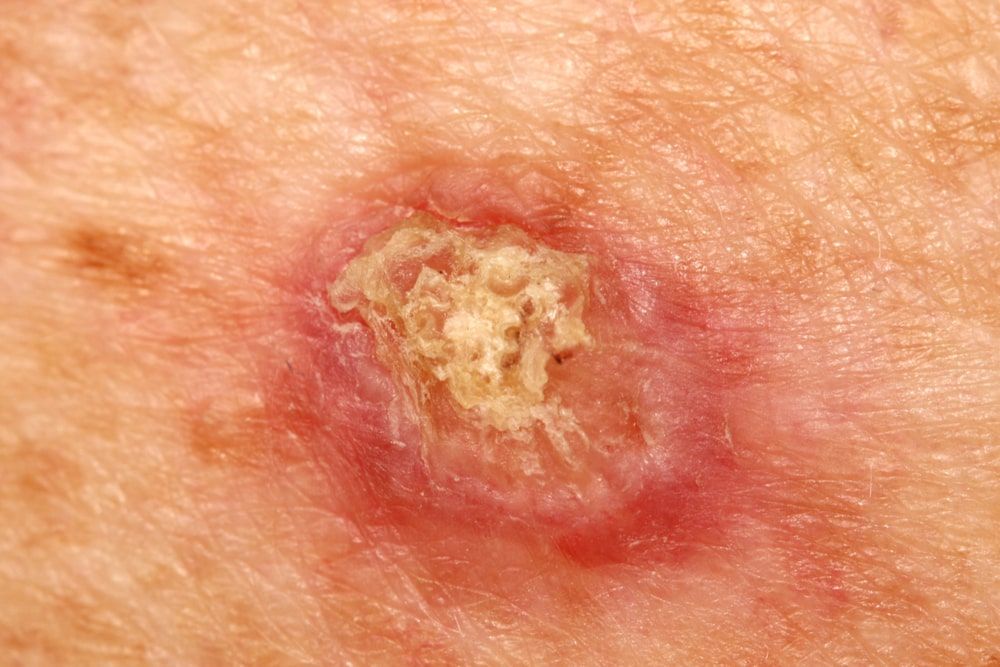 A case of an invasive squamous cell carcinoma.