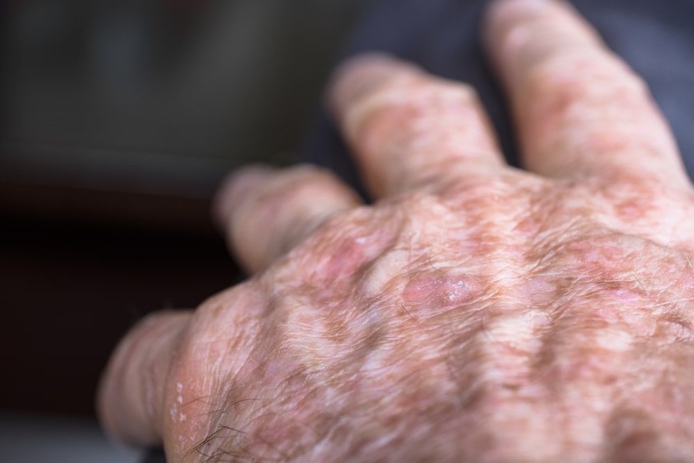 sunspots on sun-damaged skin of the hand of a man