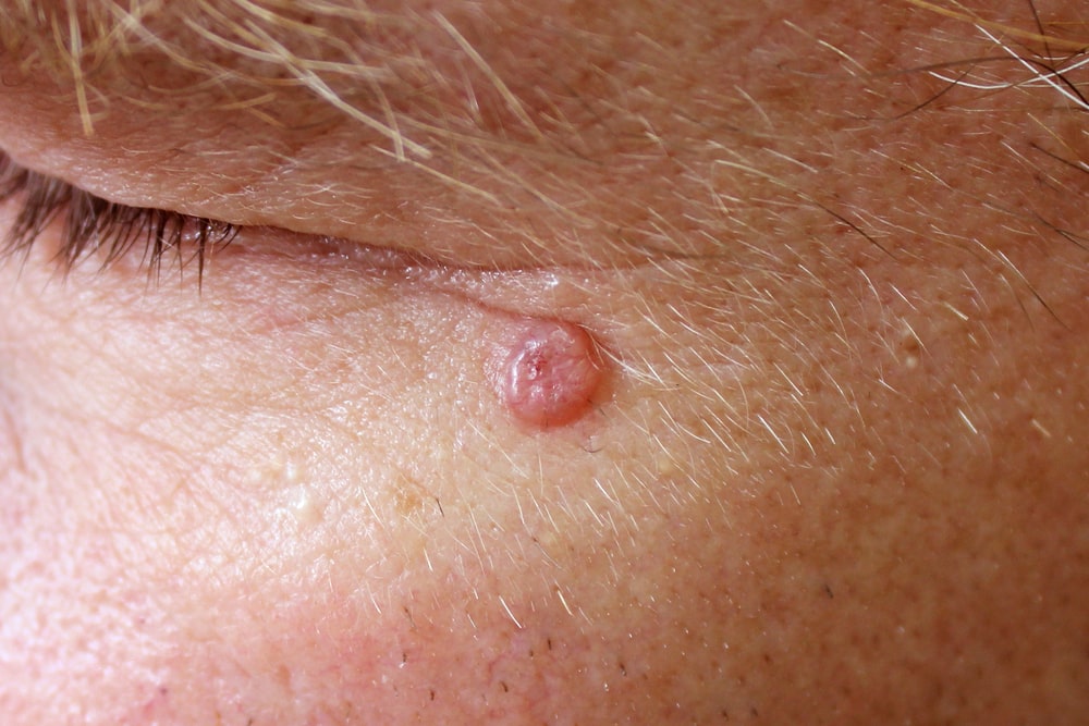 A case of nodular basal cell carcinoma