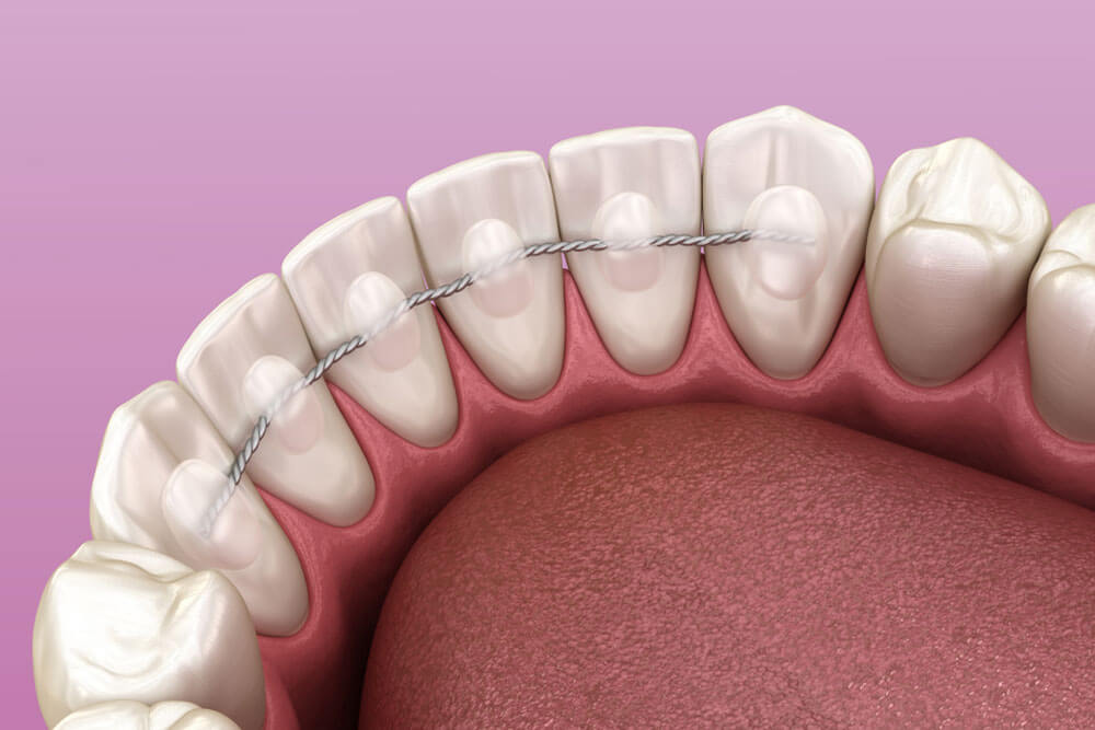 Retainers dental installed after braces treatment, Medically accurate dental 3D illustration