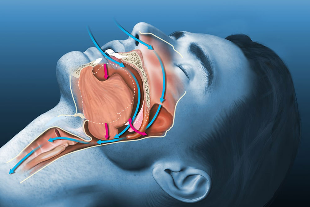 Medically 3D illustration shows a sleeping snoring man