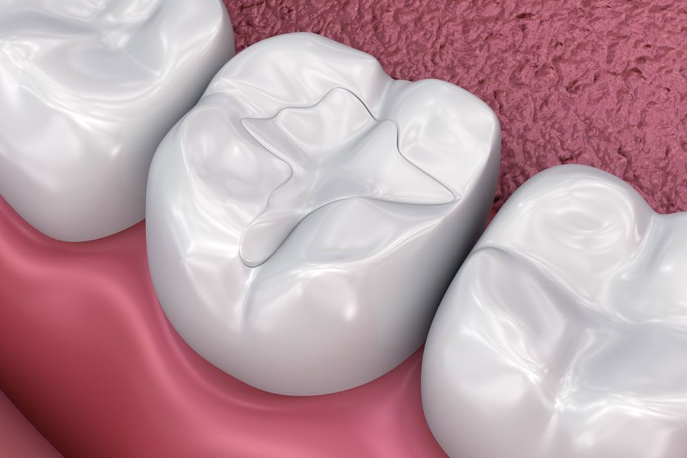 Tooth Colored Composite Resin Fillings Redwood