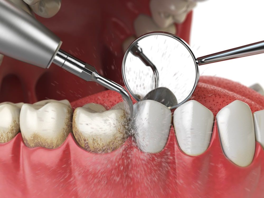 Ultrasonic teeth cleaning machine delete dental calculus from human teeth