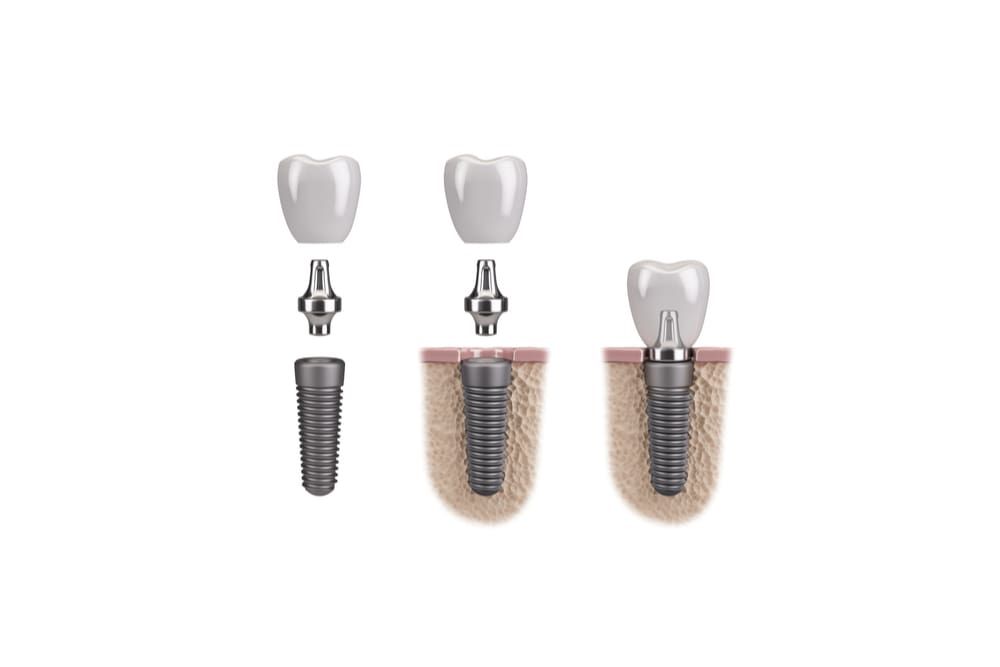 Human Tooth implant