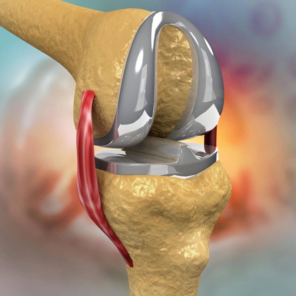 Steel knee cap on knee joint